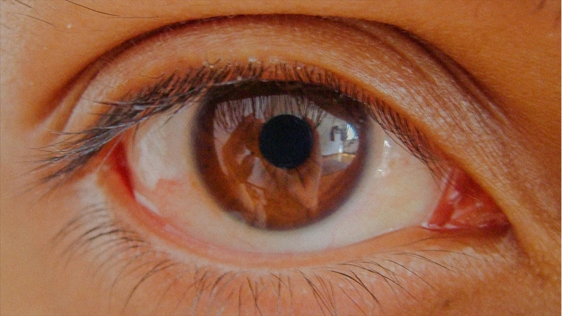 Göz tansiyonunda erken teşhis kalıcı körlüğün önüne geçiyor